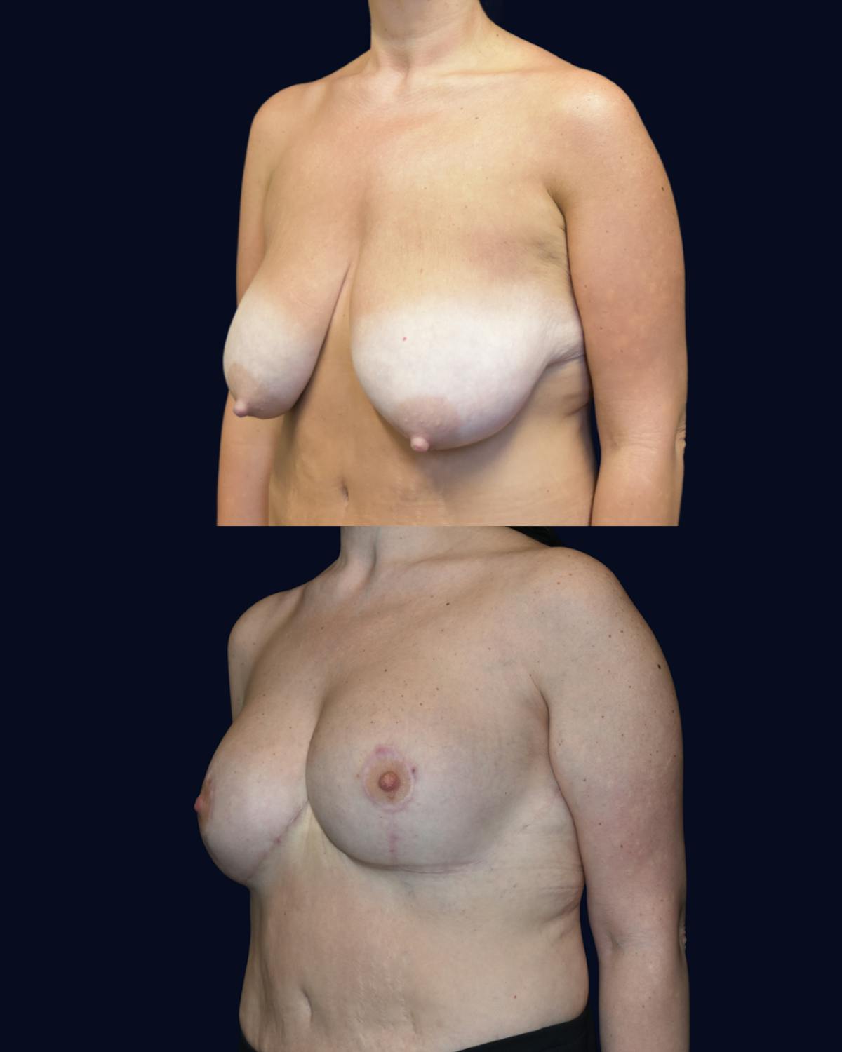 Breast Reduction and Lift with Implants Before & After Gallery - Patient 198247 - Image 3