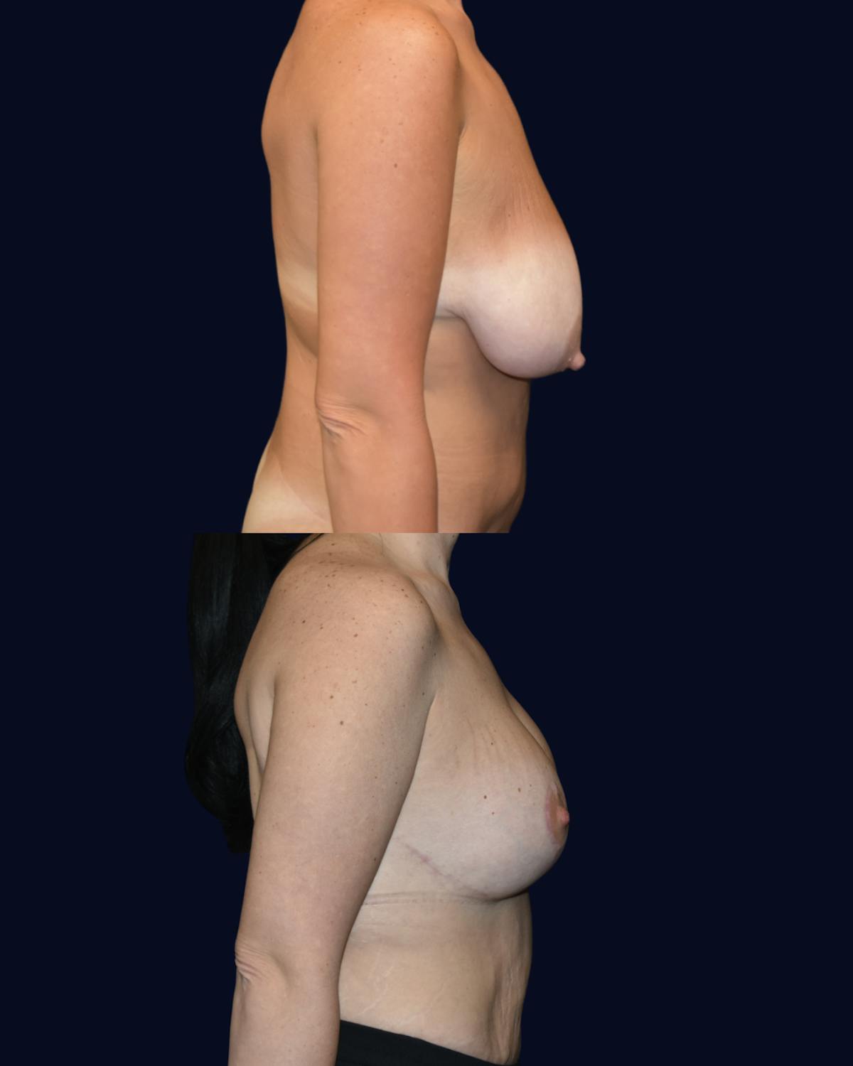 Breast Reduction and Lift with Implants Before & After Gallery - Patient 198247 - Image 4