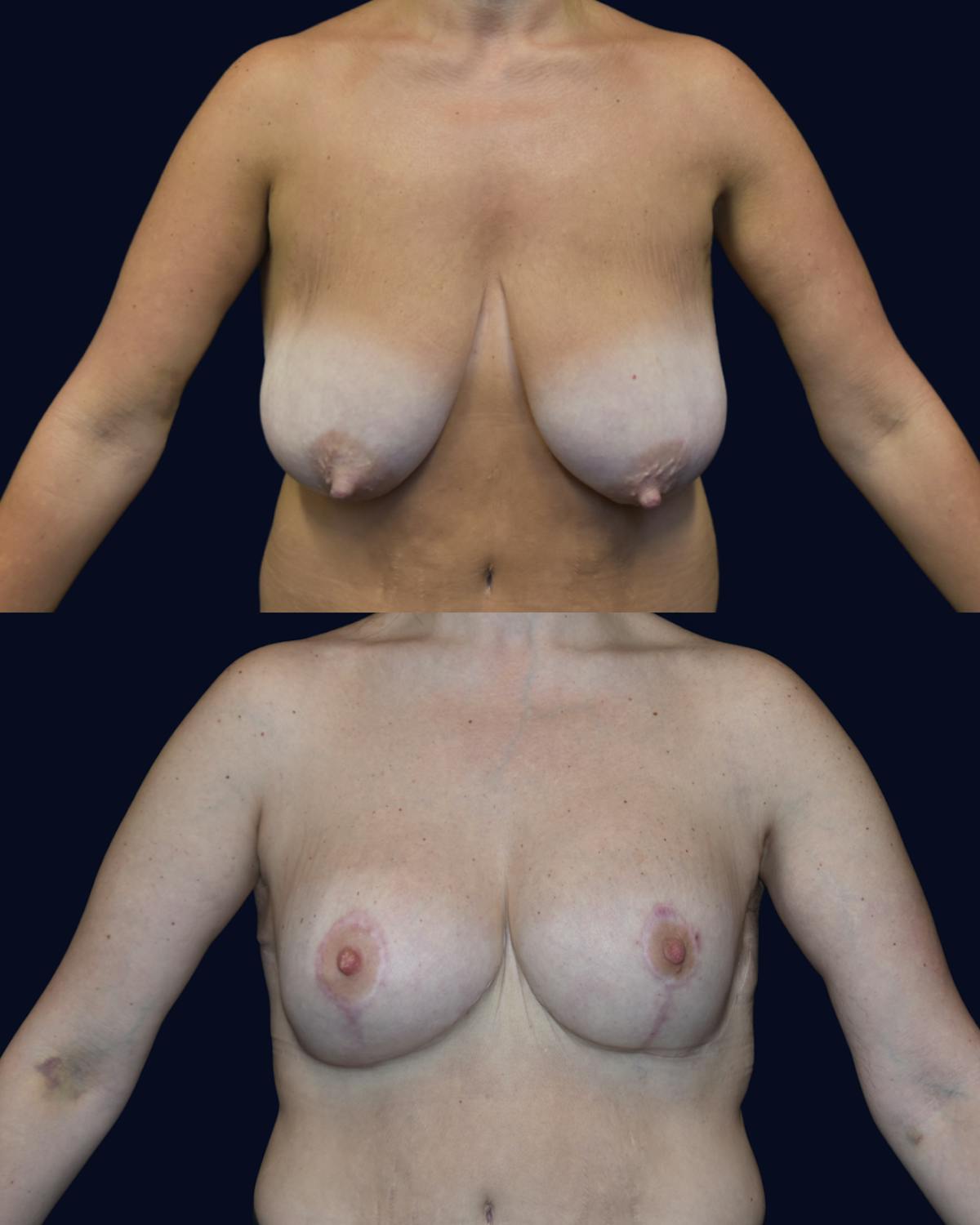 Breast Reduction and Lift with Implants Before & After Gallery - Patient 198247 - Image 2
