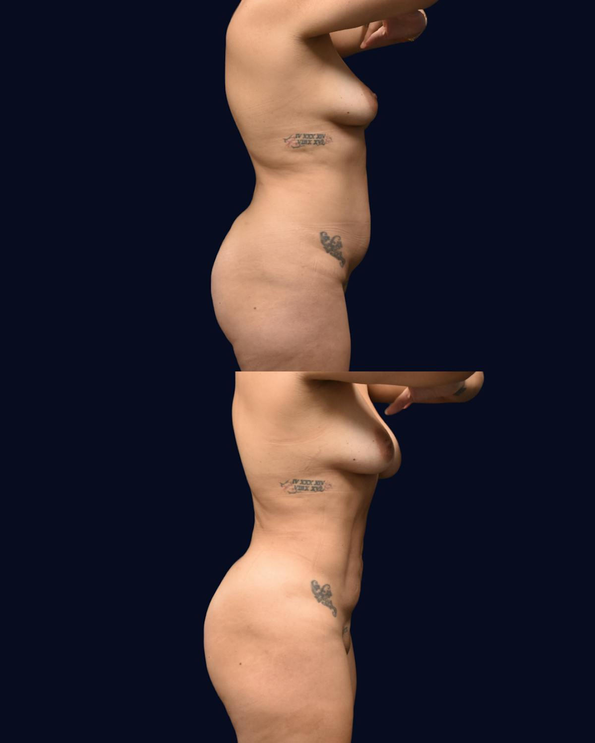 Liposuction Before & After Gallery - Patient 248055 - Image 3