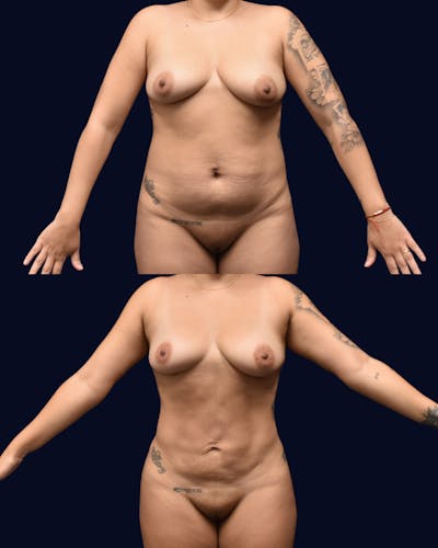 Liposuction Before & After Gallery - Patient 248055 - Image 1