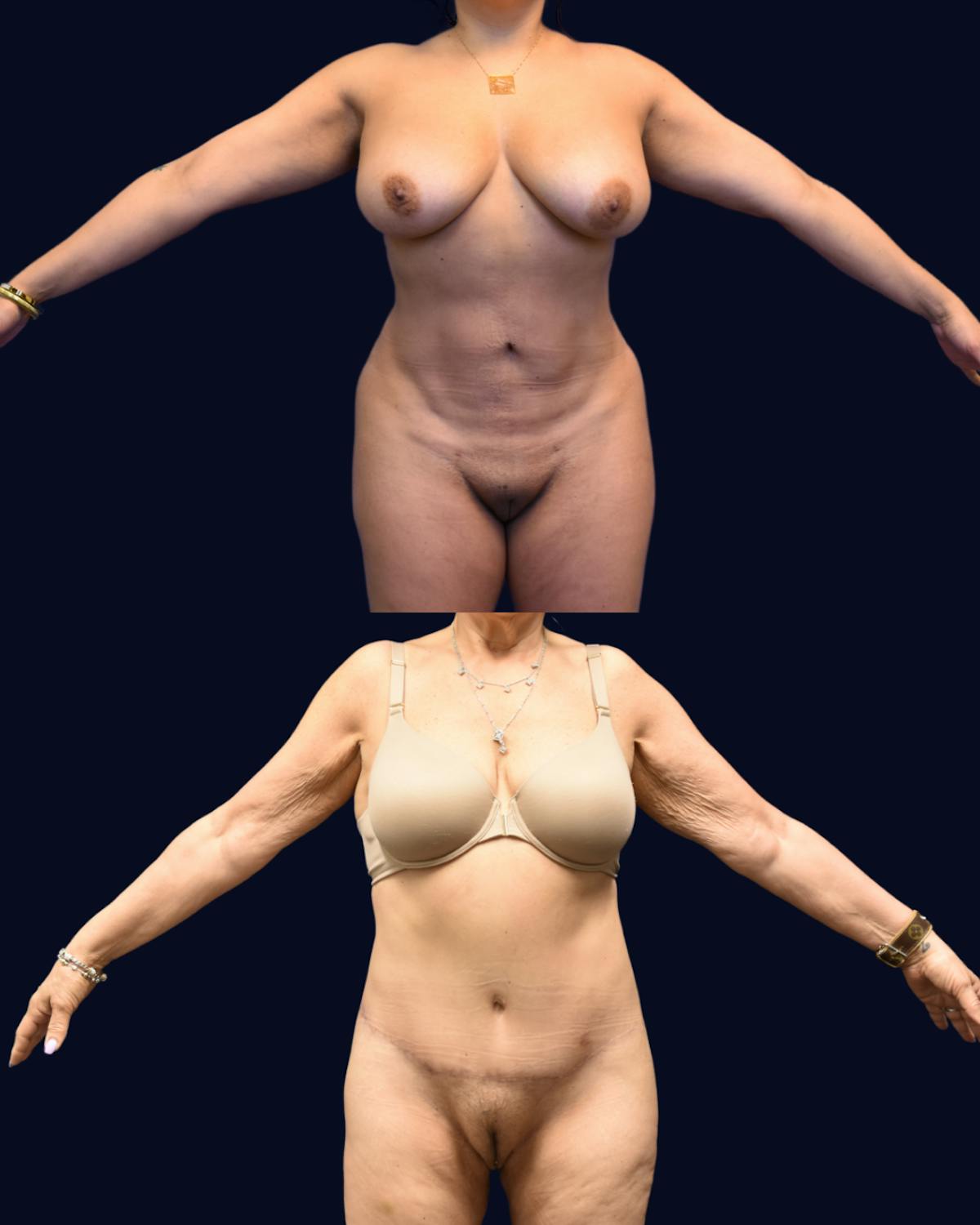 Abdominoplasty with Liposuction Before & After Gallery - Patient 367394 - Image 2