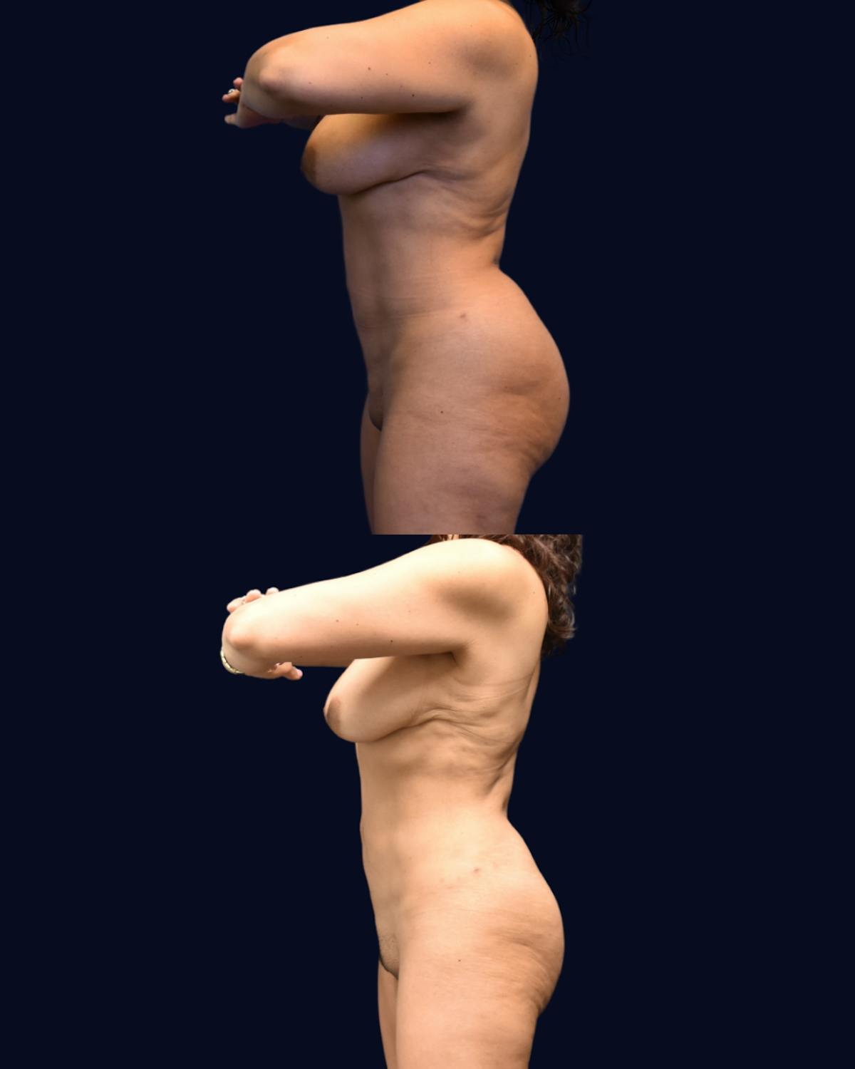 Abdominoplasty with Liposuction Before & After Gallery - Patient 367394 - Image 4