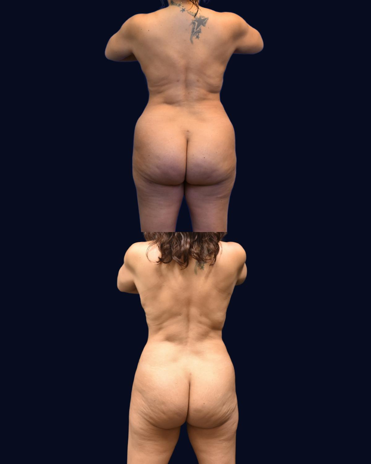 Abdominoplasty with Liposuction Before & After Gallery - Patient 367394 - Image 5