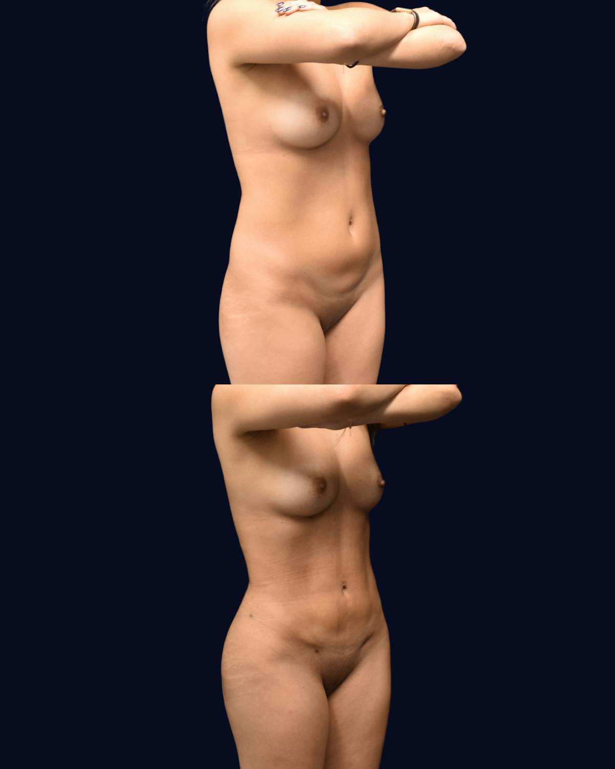 Abdominoplasty with Liposuction Before & After Gallery - Patient 118399 - Image 2