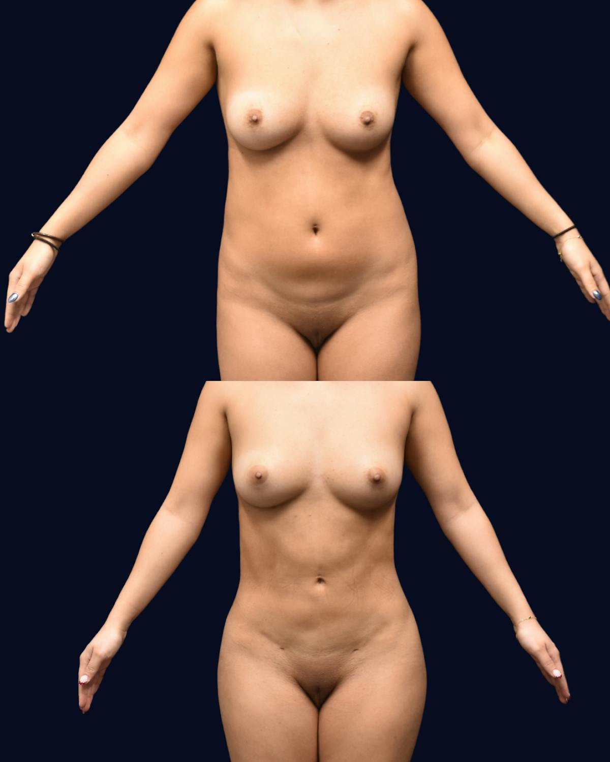 Abdominoplasty with Liposuction Before & After Gallery - Patient 118399 - Image 1