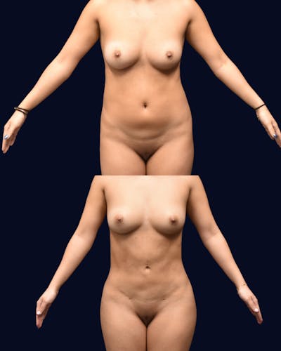 Abdominoplasty with Liposuction Before & After Gallery - Patient 118399 - Image 1