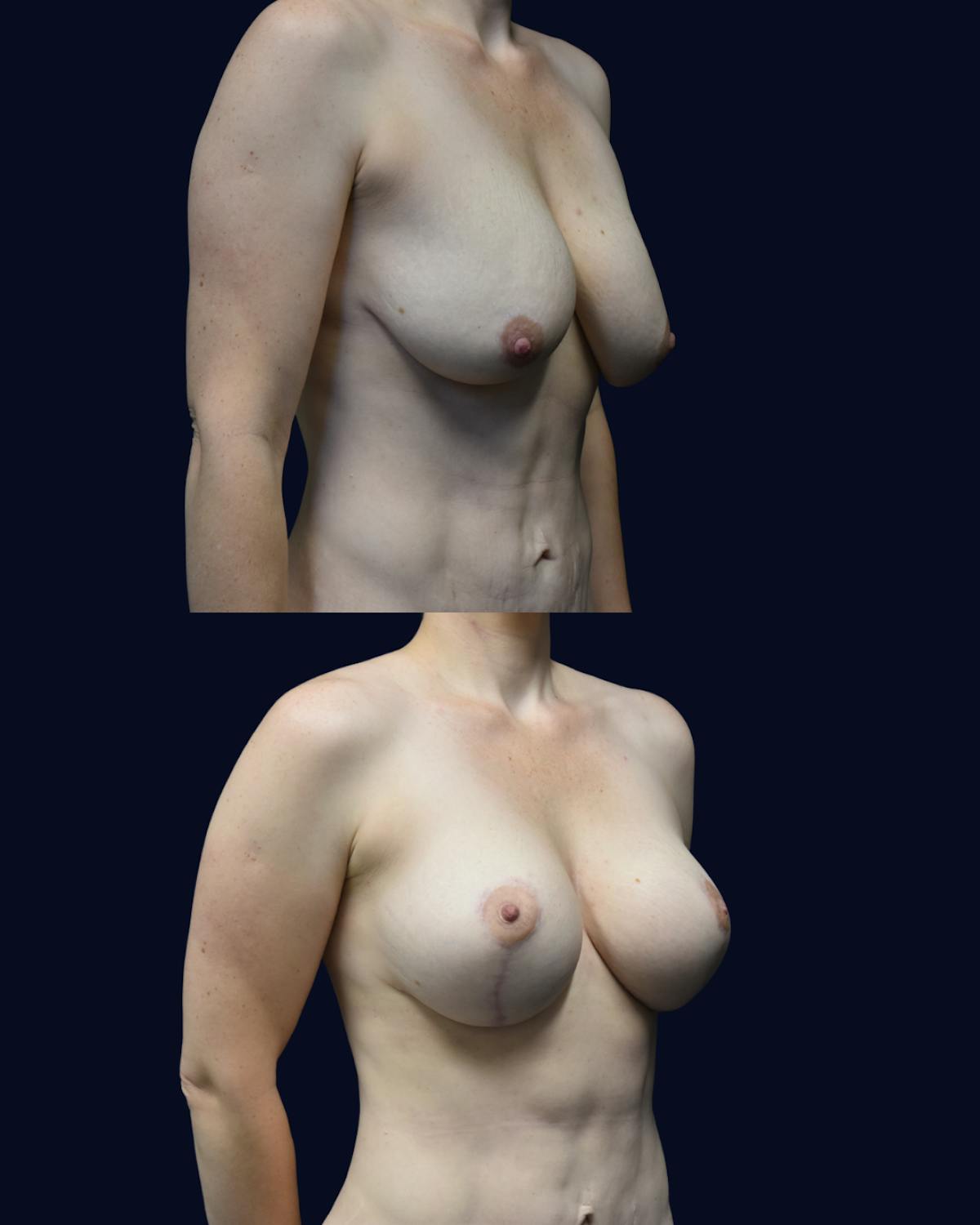 Mommy Makeover Before & After Gallery - Patient 692404 - Image 2