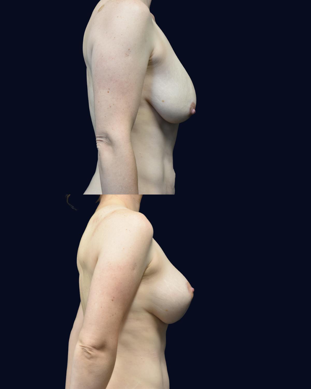 Mommy Makeover Before & After Gallery - Patient 692404 - Image 3