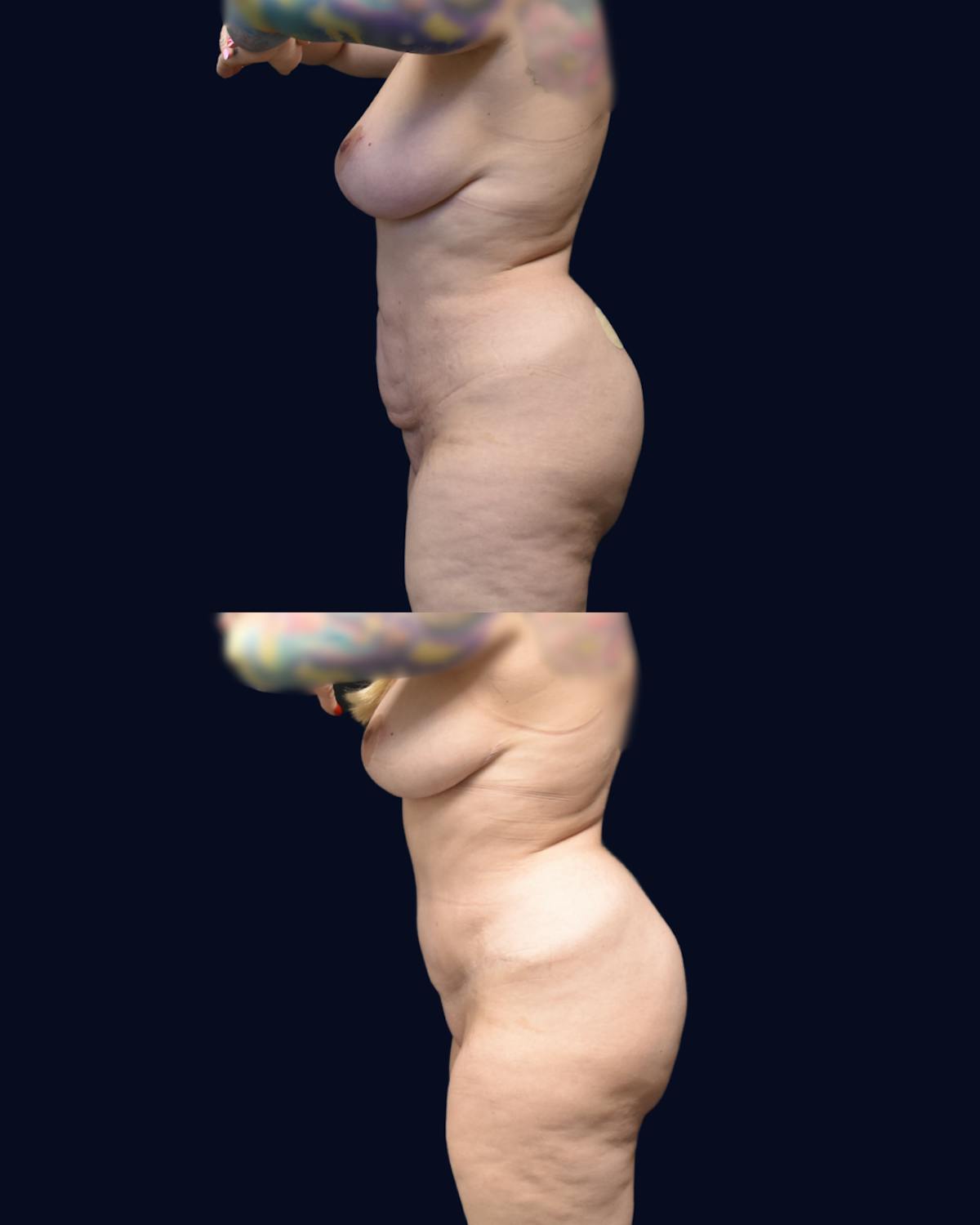 Mommy Makeover Before & After Gallery - Patient 197743 - Image 3