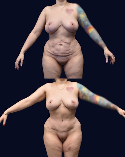 Mommy Makeover Before & After Gallery - Patient 197743 - Image 1