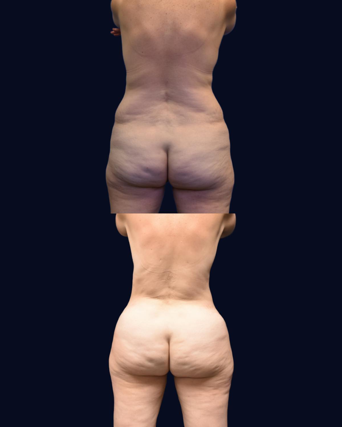Abdominoplasty with Liposuction Before & After Gallery - Patient 932661 - Image 4