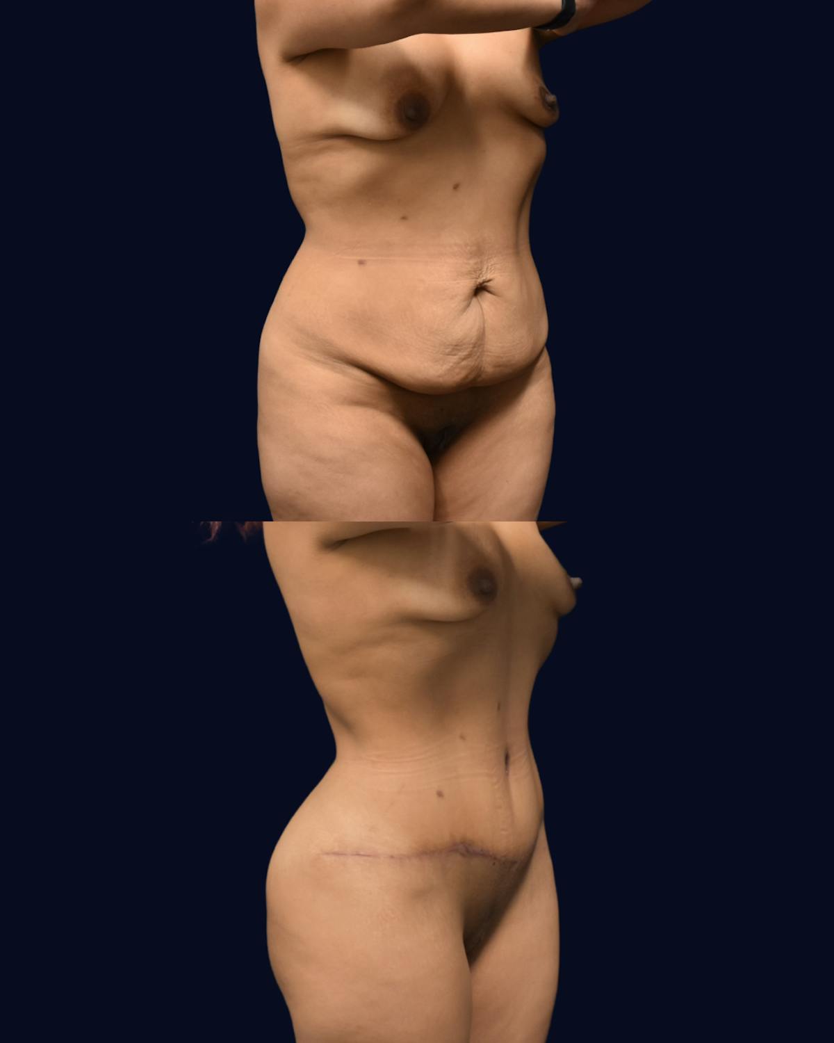 Mommy Makeover Before & After Gallery - Patient 783166 - Image 2