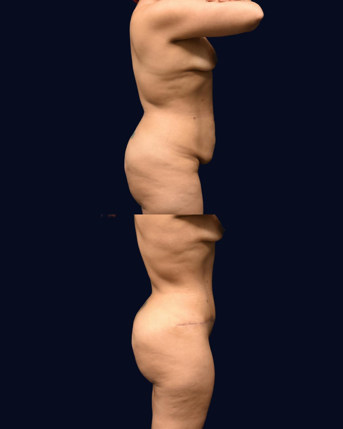 Mommy Makeover Before & After Gallery - Patient 783166 - Image 3