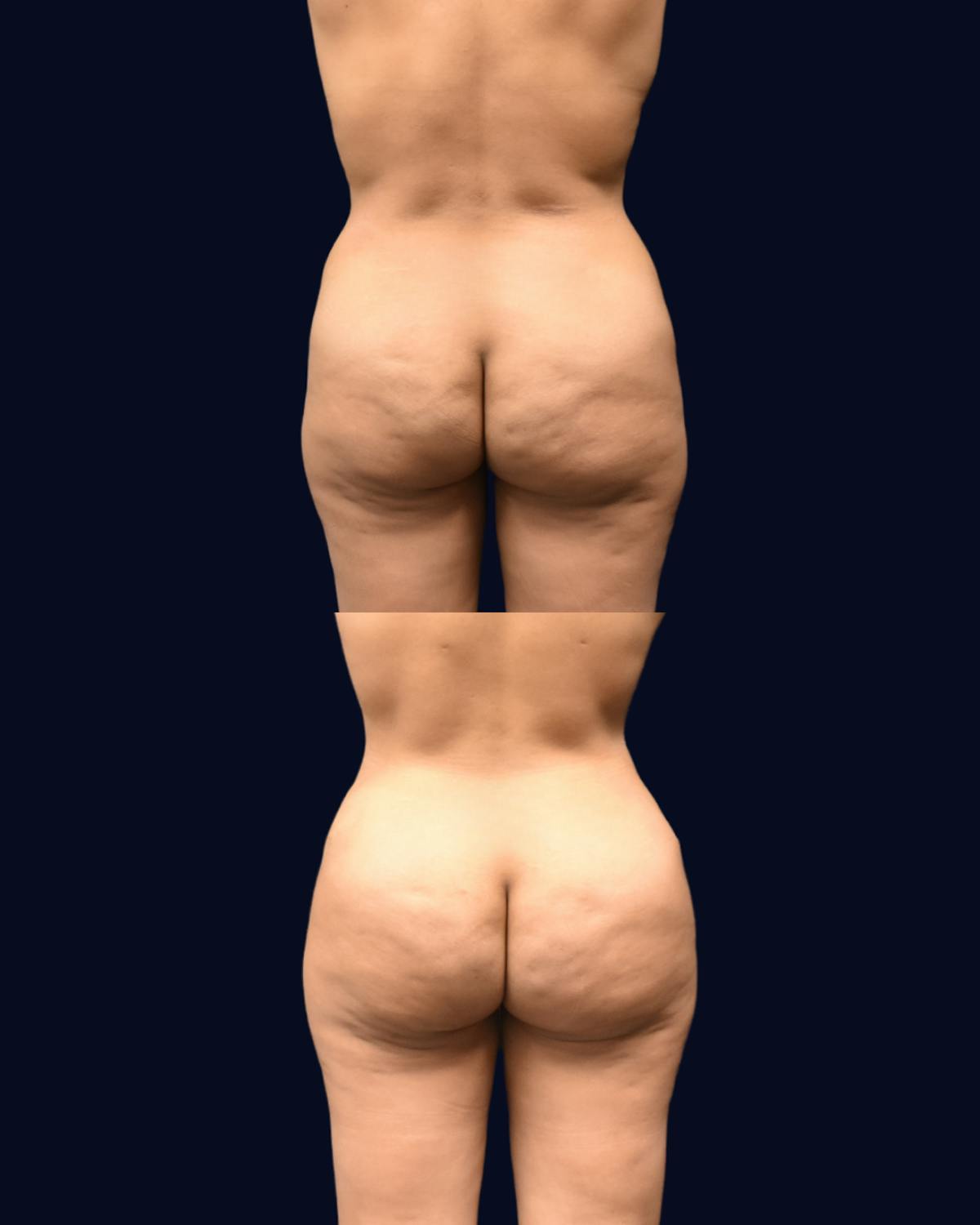 Mommy Makeover Before & After Gallery - Patient 783166 - Image 4