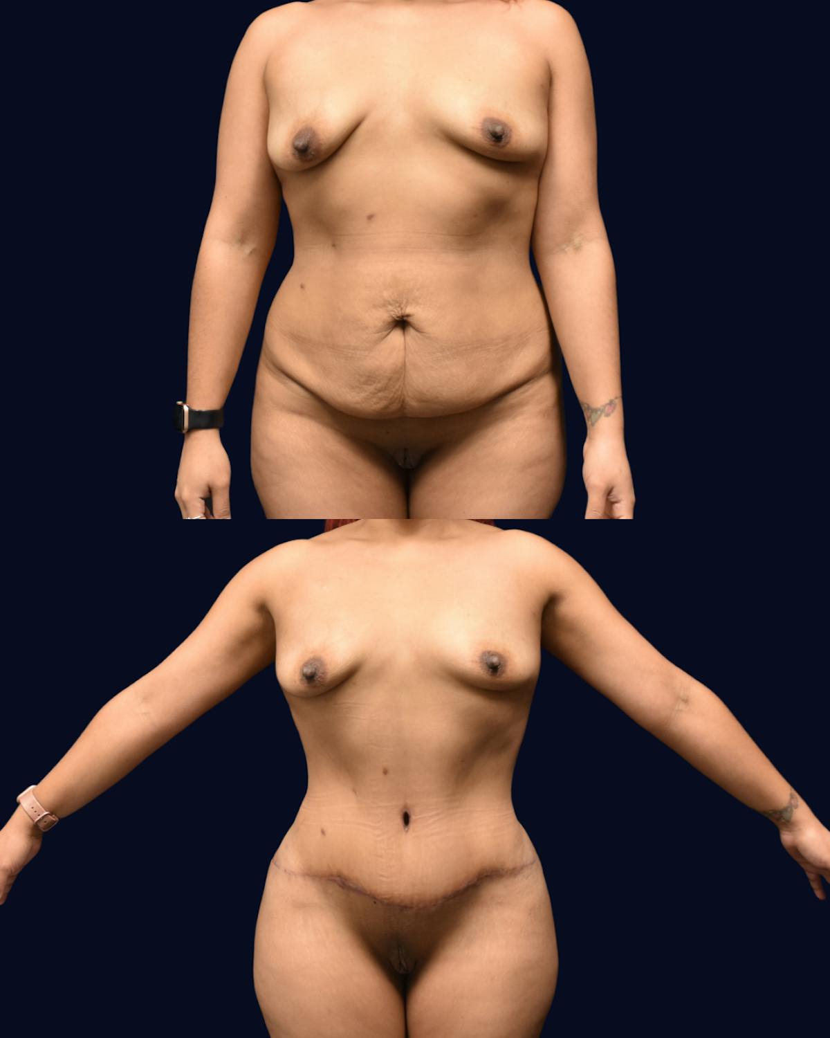 Mommy Makeover Before & After Gallery - Patient 783166 - Image 1