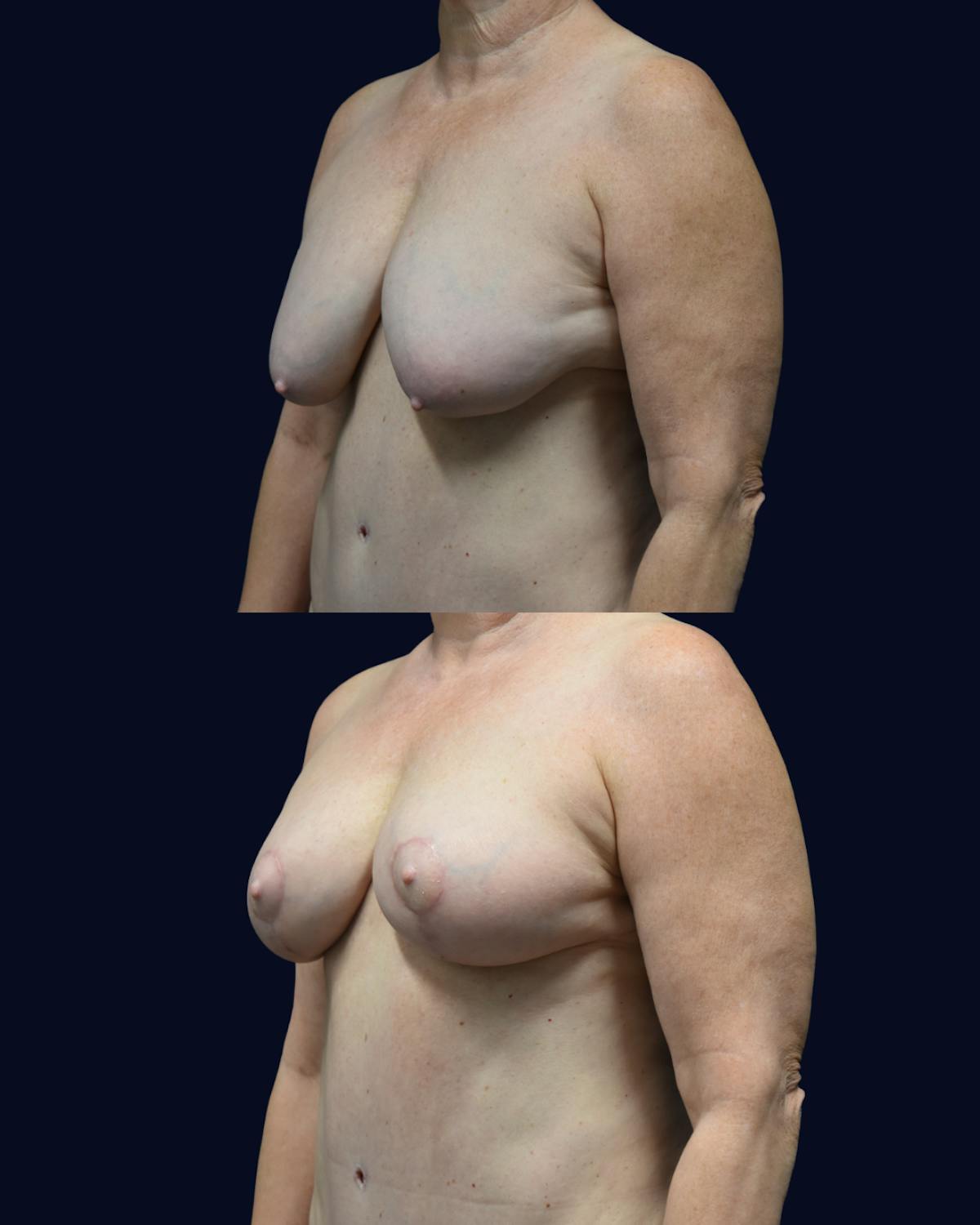Breast Reduction and Lift Before & After Gallery - Patient 110578 - Image 2