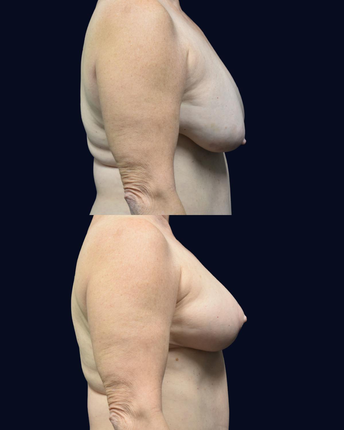 Breast Reduction and Lift Before & After Gallery - Patient 110578 - Image 3