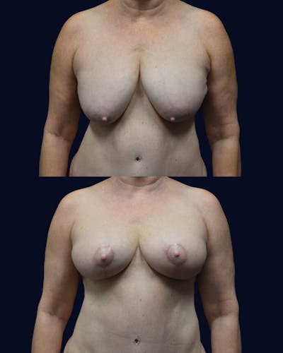 Breast Reduction and Lift Before & After Gallery - Patient 110578 - Image 1