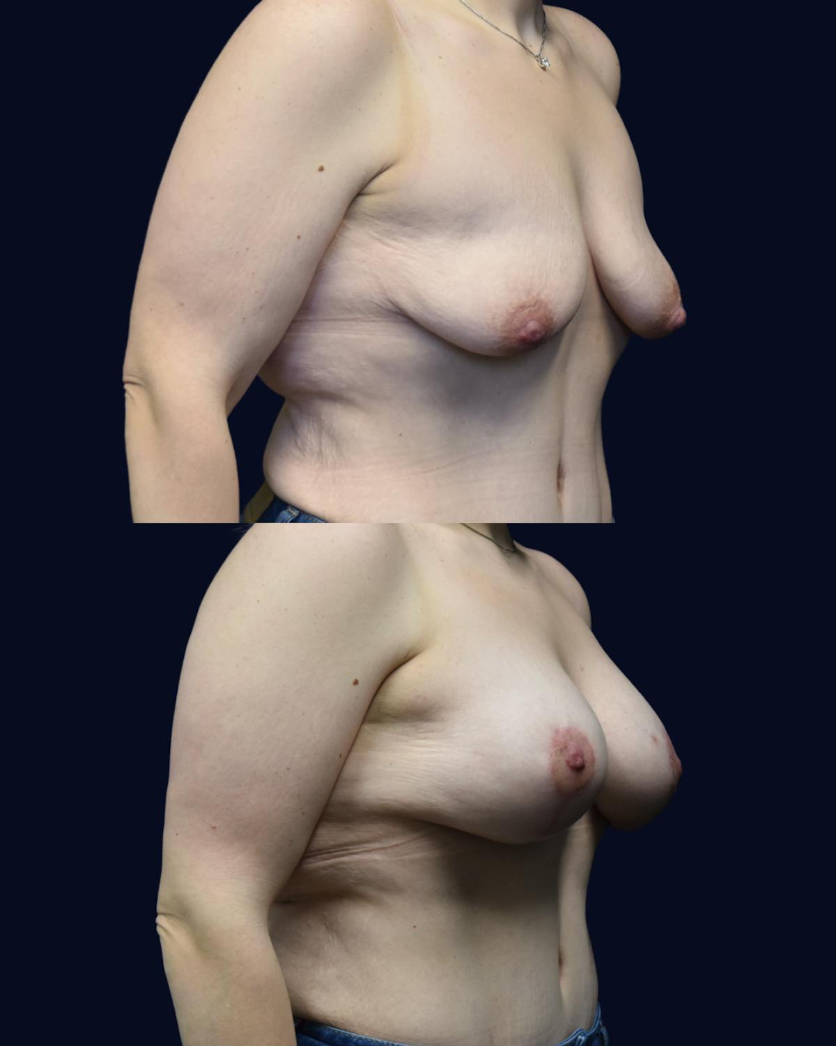 Brachioplasty (Arm Lift) Before & After Gallery - Patient 193626 - Image 4