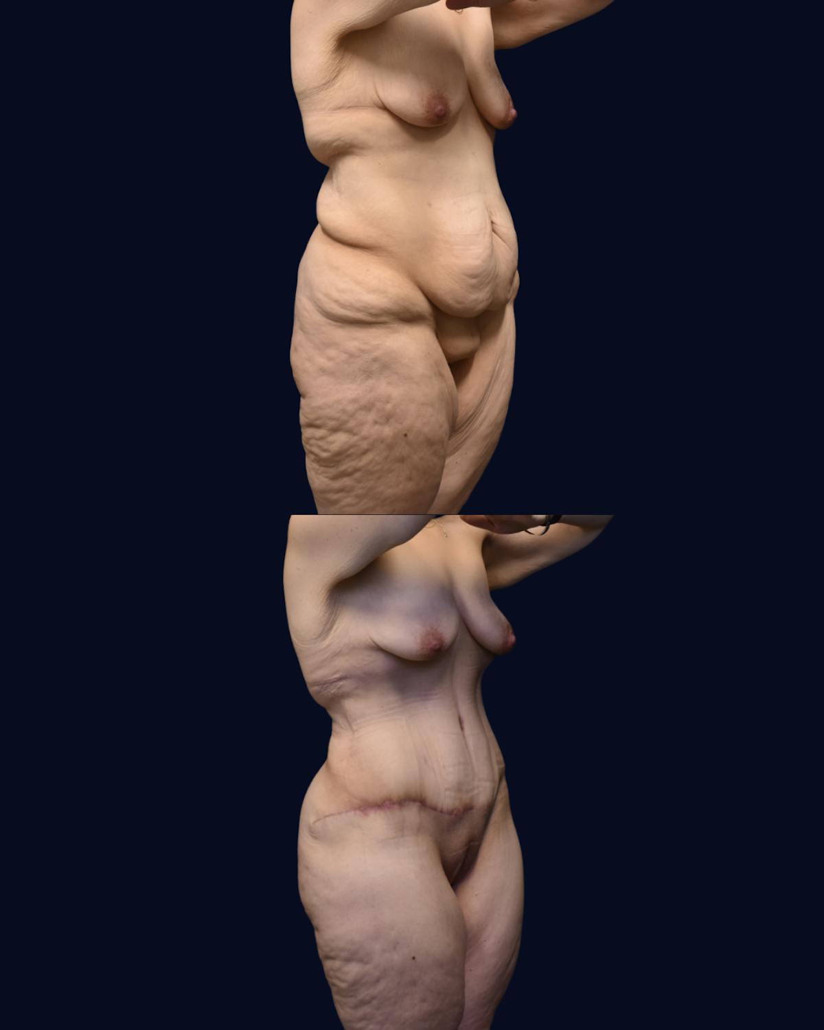 Brachioplasty (Arm Lift) Before & After Gallery - Patient 193626 - Image 6