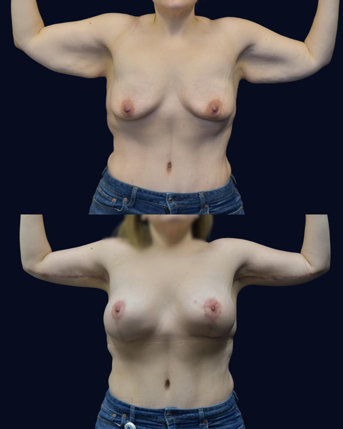 Brachioplasty (Arm Lift) Before & After Gallery - Patient 193626 - Image 2