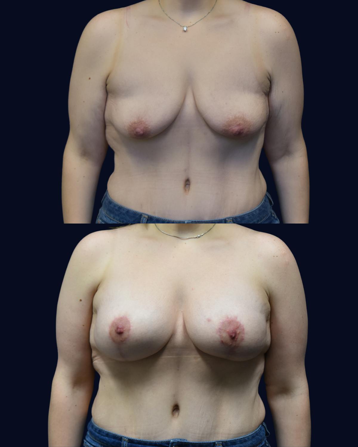 Brachioplasty (Arm Lift) Before & After Gallery - Patient 193626 - Image 3