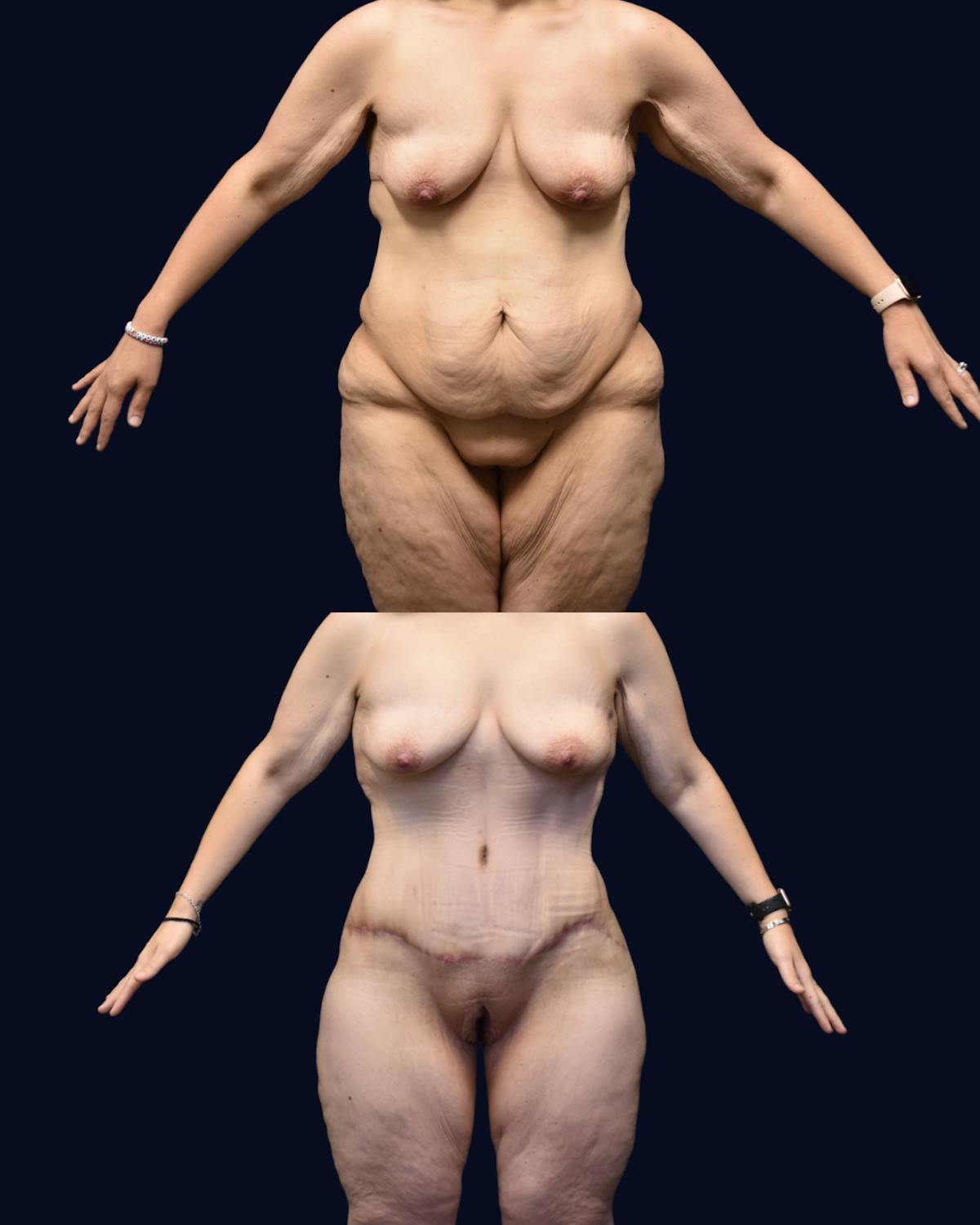 Brachioplasty (Arm Lift) Before & After Gallery - Patient 193626 - Image 5