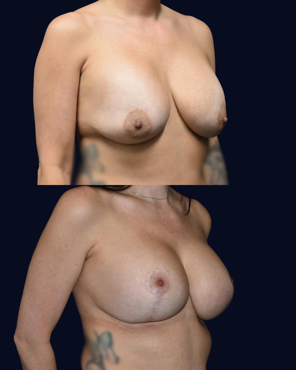 Breast Reduction and Lift Without Implants Before & After Gallery - Patient 222102 - Image 2