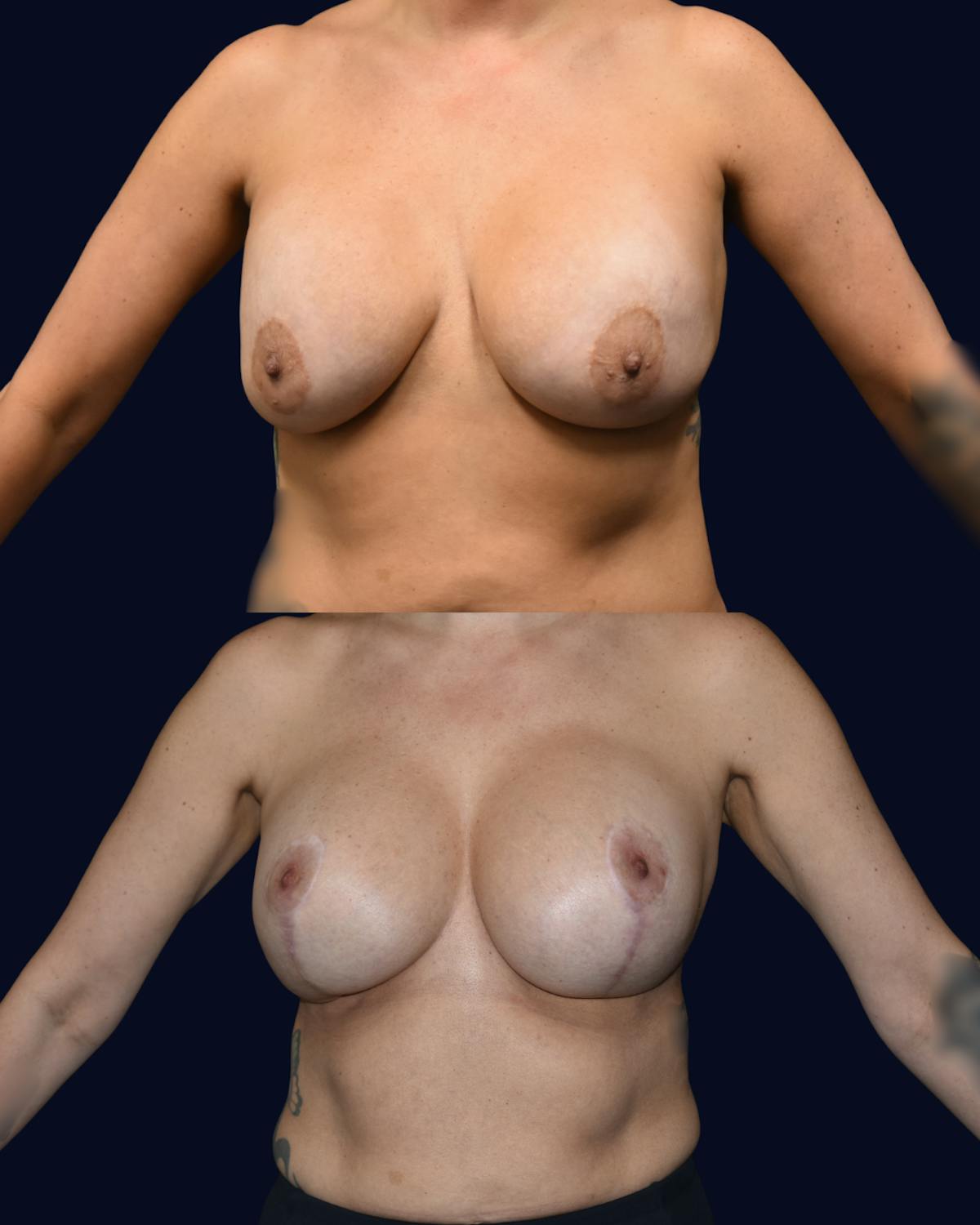 Breast Reduction and Lift Without Implants Before & After Gallery - Patient 222102 - Image 1
