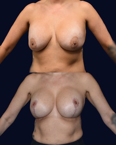 Breast Reduction and Lift Without Implants Before & After Gallery - Patient 222102 - Image 1
