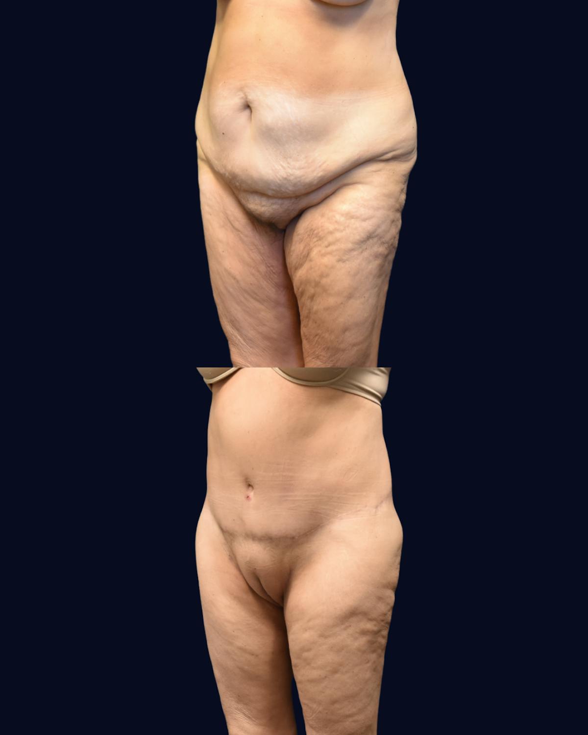Thigh Lift with Liposuction Before & After Gallery - Patient 417950 - Image 2