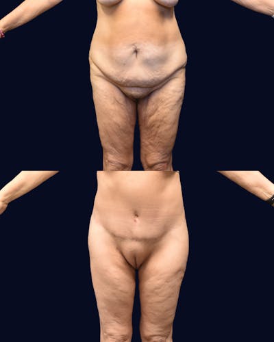 Thigh Lift with Liposuction Before & After Gallery - Patient 417950 - Image 1