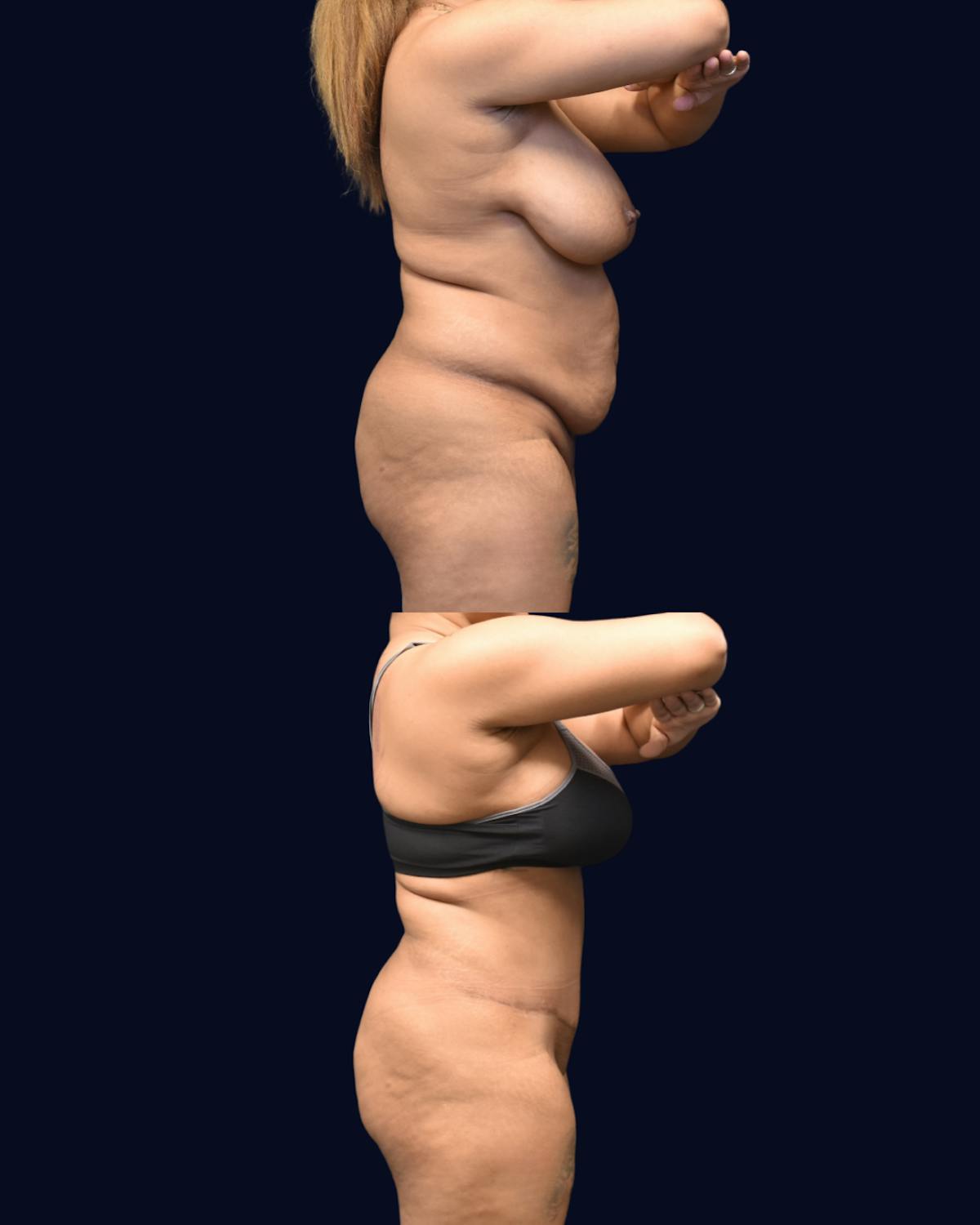 Abdominoplasty (Tummy Tuck) Before & After Gallery - Patient 288552 - Image 5