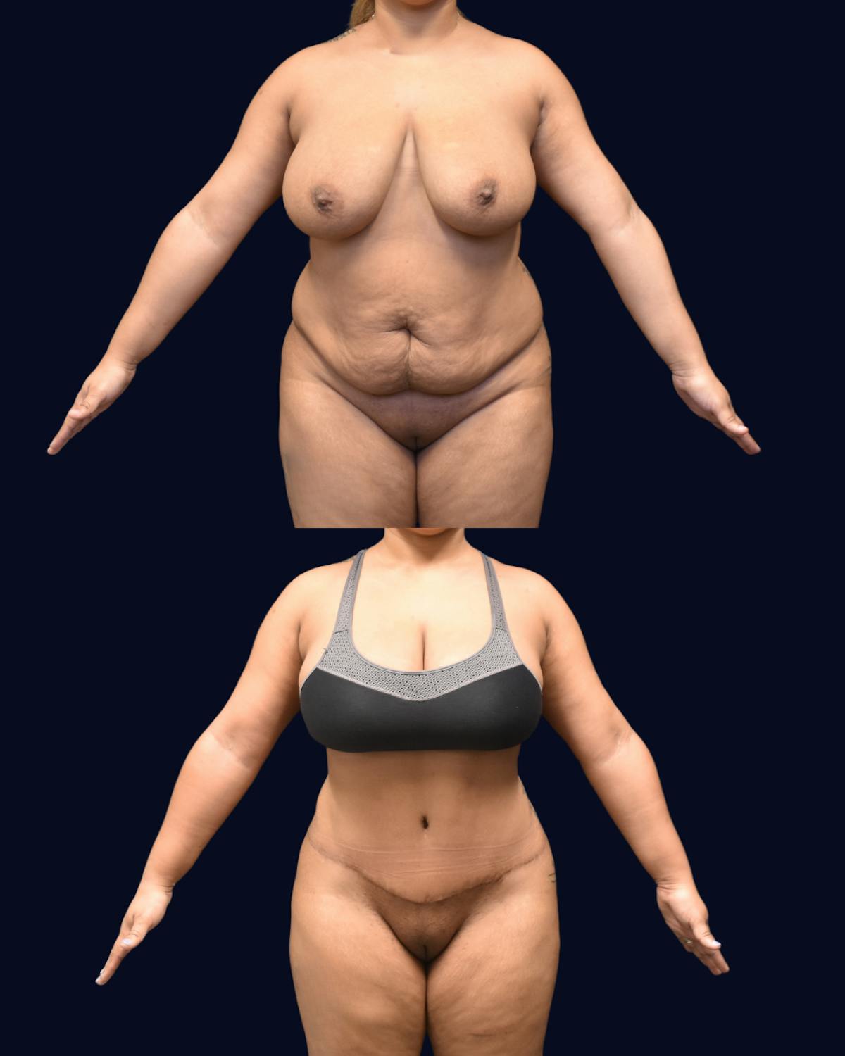 Abdominoplasty (Tummy Tuck) Before & After Gallery - Patient 288552 - Image 2