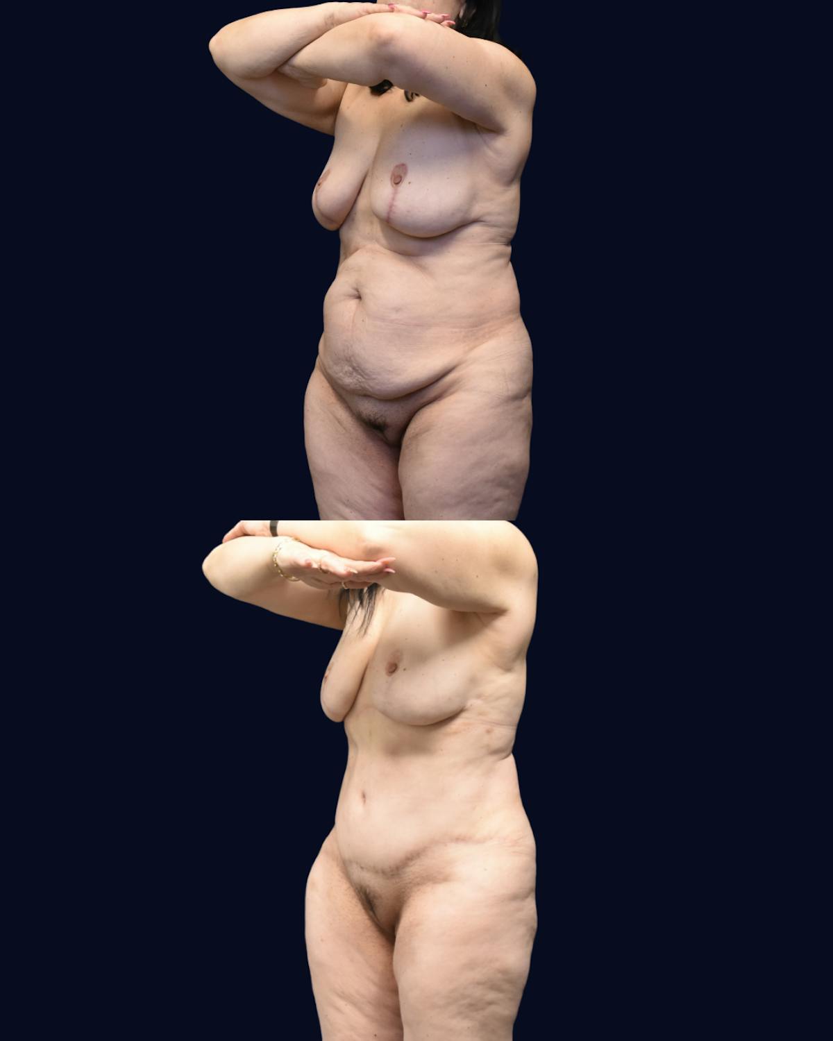 Abdominoplasty (Tummy Tuck) Before & After Gallery - Patient 288552 - Image 7