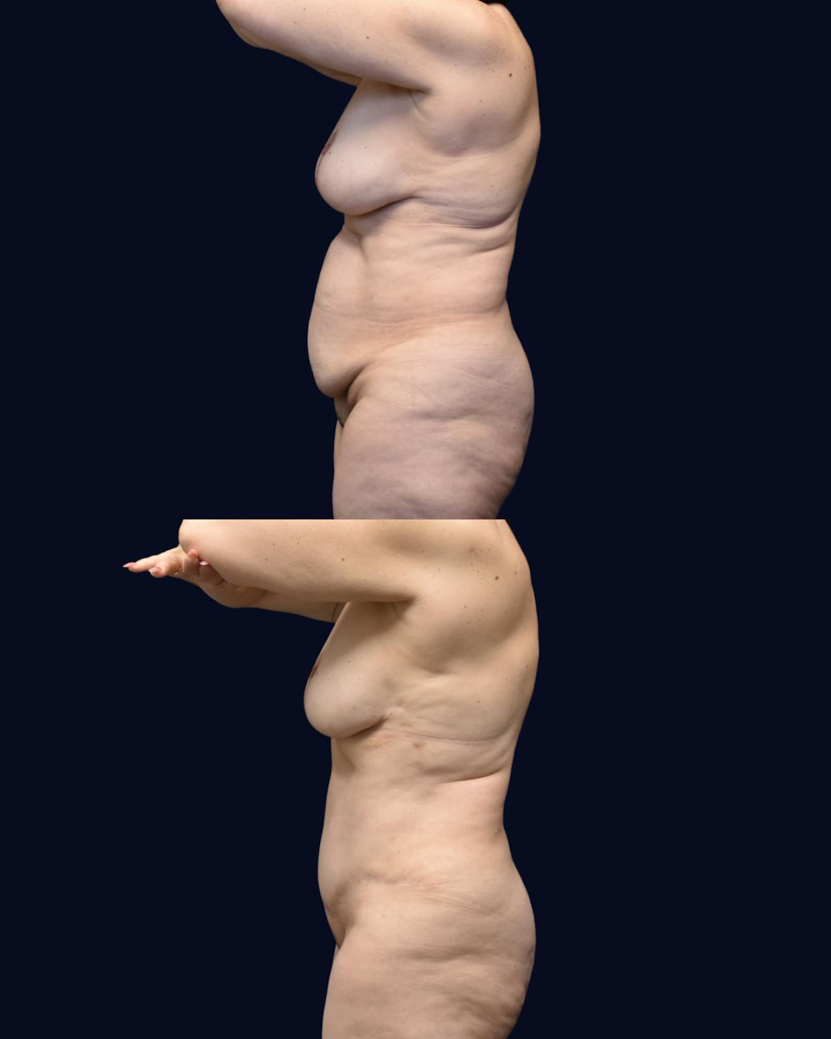 Abdominoplasty (Tummy Tuck) Before & After Gallery - Patient 288552 - Image 6