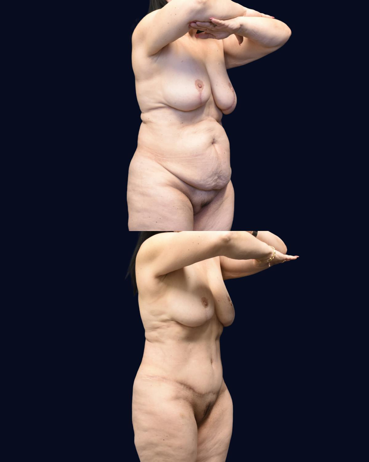 Abdominoplasty (Tummy Tuck) Before & After Gallery - Patient 288552 - Image 4
