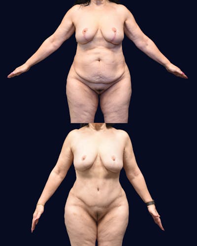 Abdominoplasty (Tummy Tuck) Before & After Gallery - Patient 288552 - Image 1