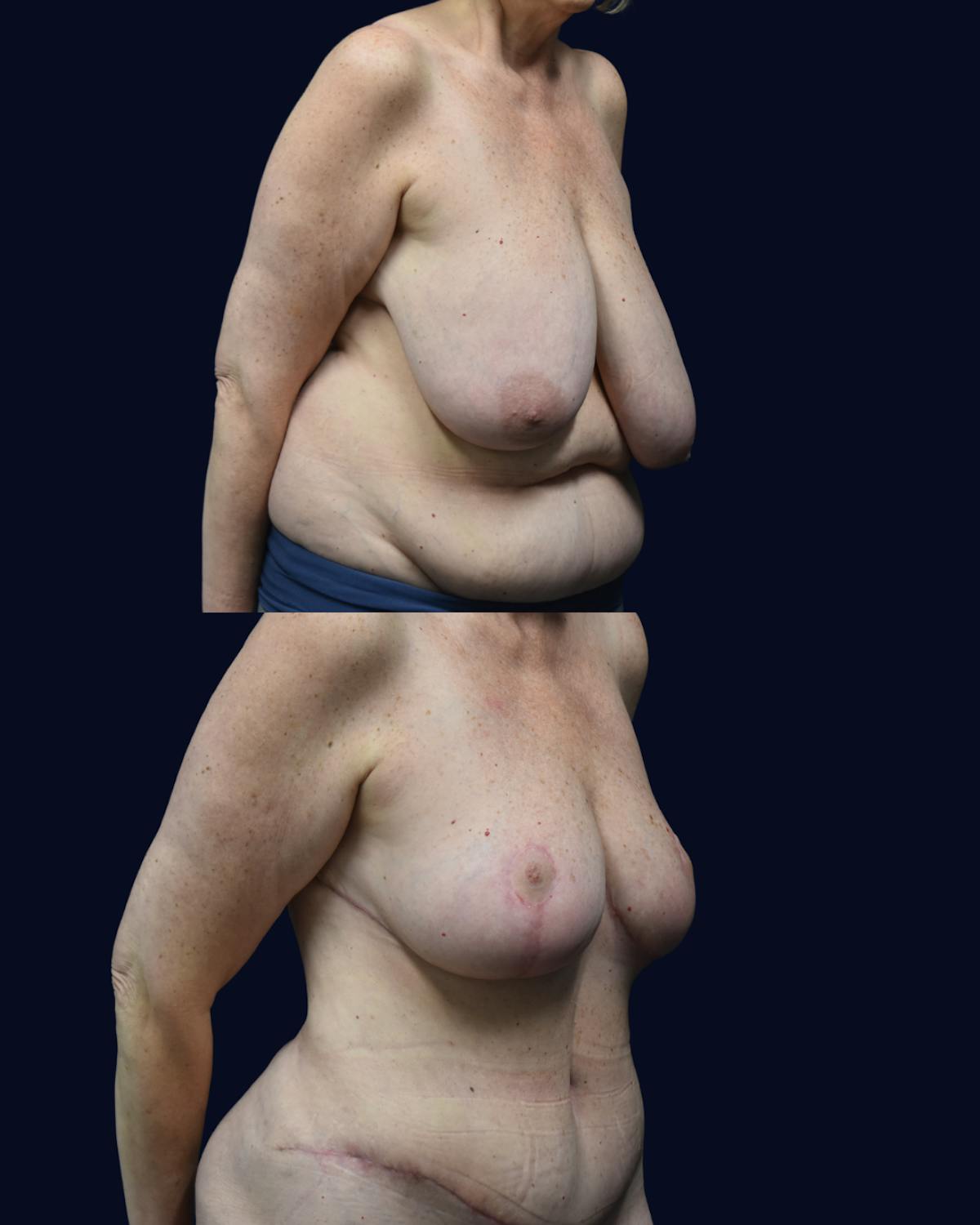 Mommy Makeover Before & After Gallery - Patient 277211 - Image 2