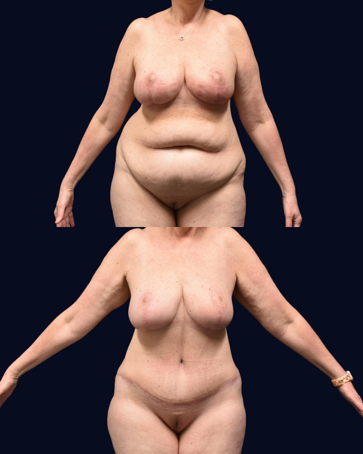 Mommy Makeover Before & After Gallery - Patient 277211 - Image 3