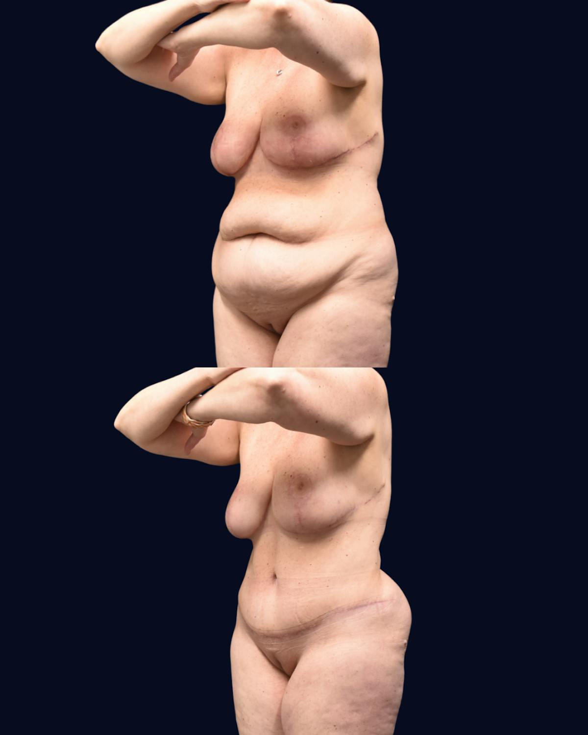 Mommy Makeover Before & After Gallery - Patient 277211 - Image 4