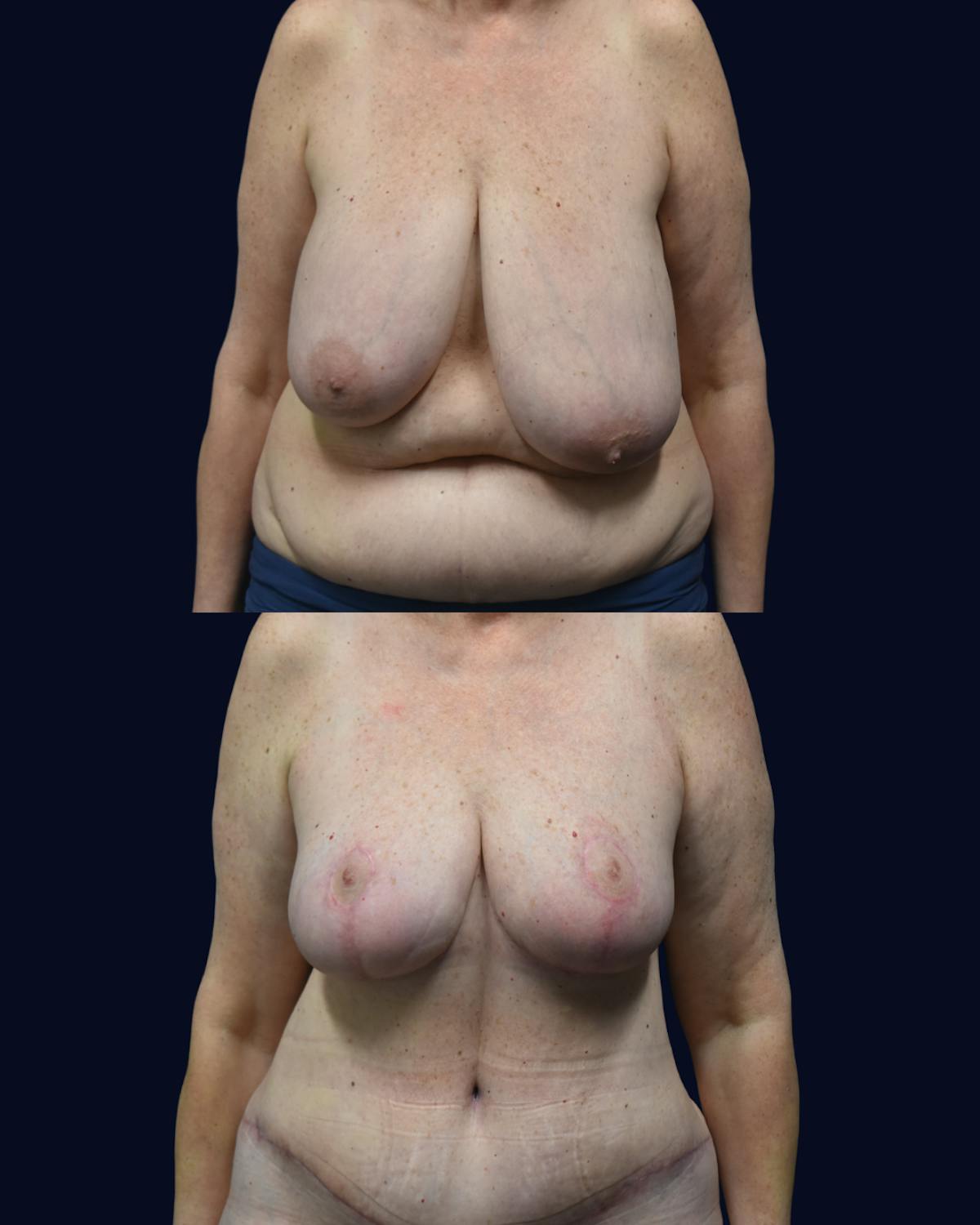 Mommy Makeover Before & After Gallery - Patient 277211 - Image 1