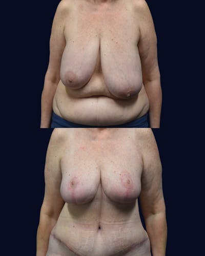 Mommy Makeover Before & After Gallery - Patient 277211 - Image 1