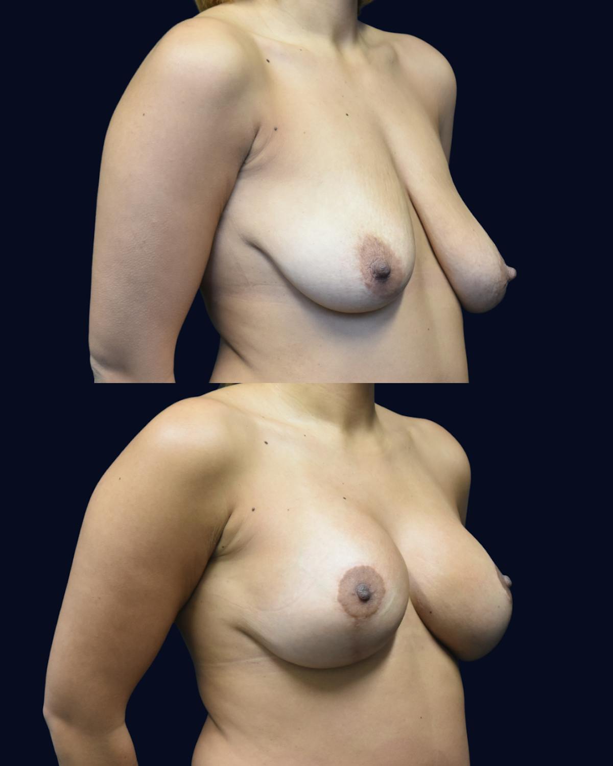 Breast Reduction and Lift Without Implants Before & After Gallery - Patient 294770 - Image 2