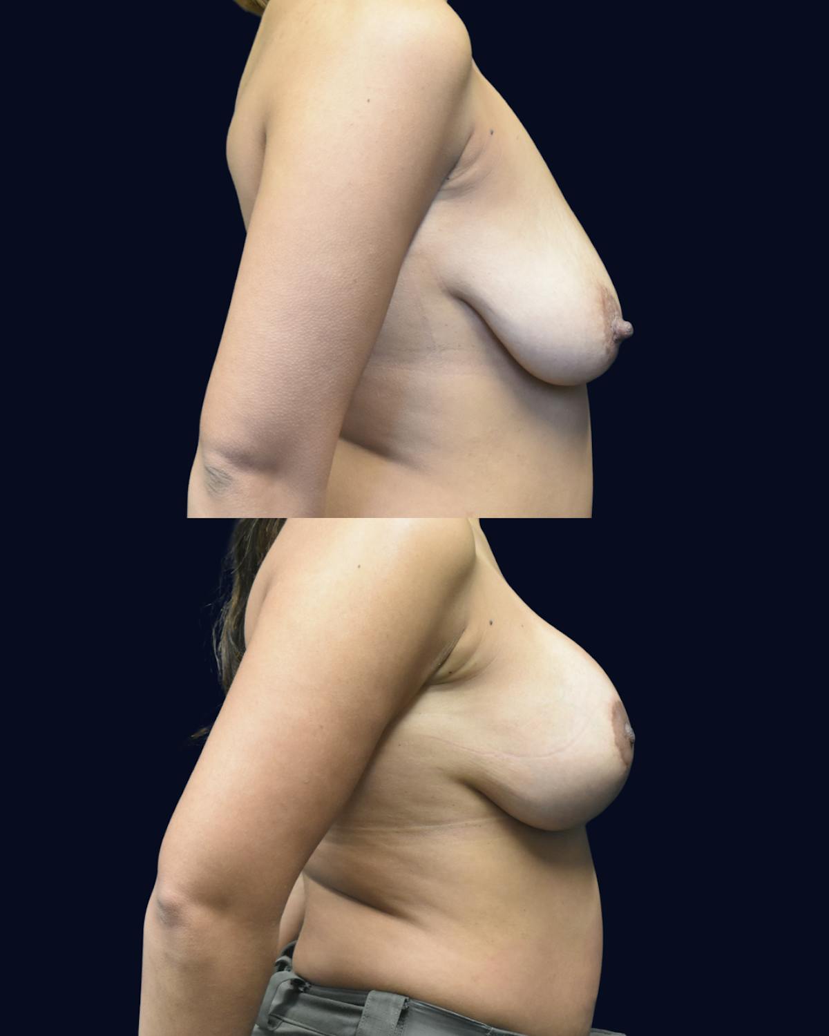 Breast Reduction and Lift Without Implants Before & After Gallery - Patient 294770 - Image 3