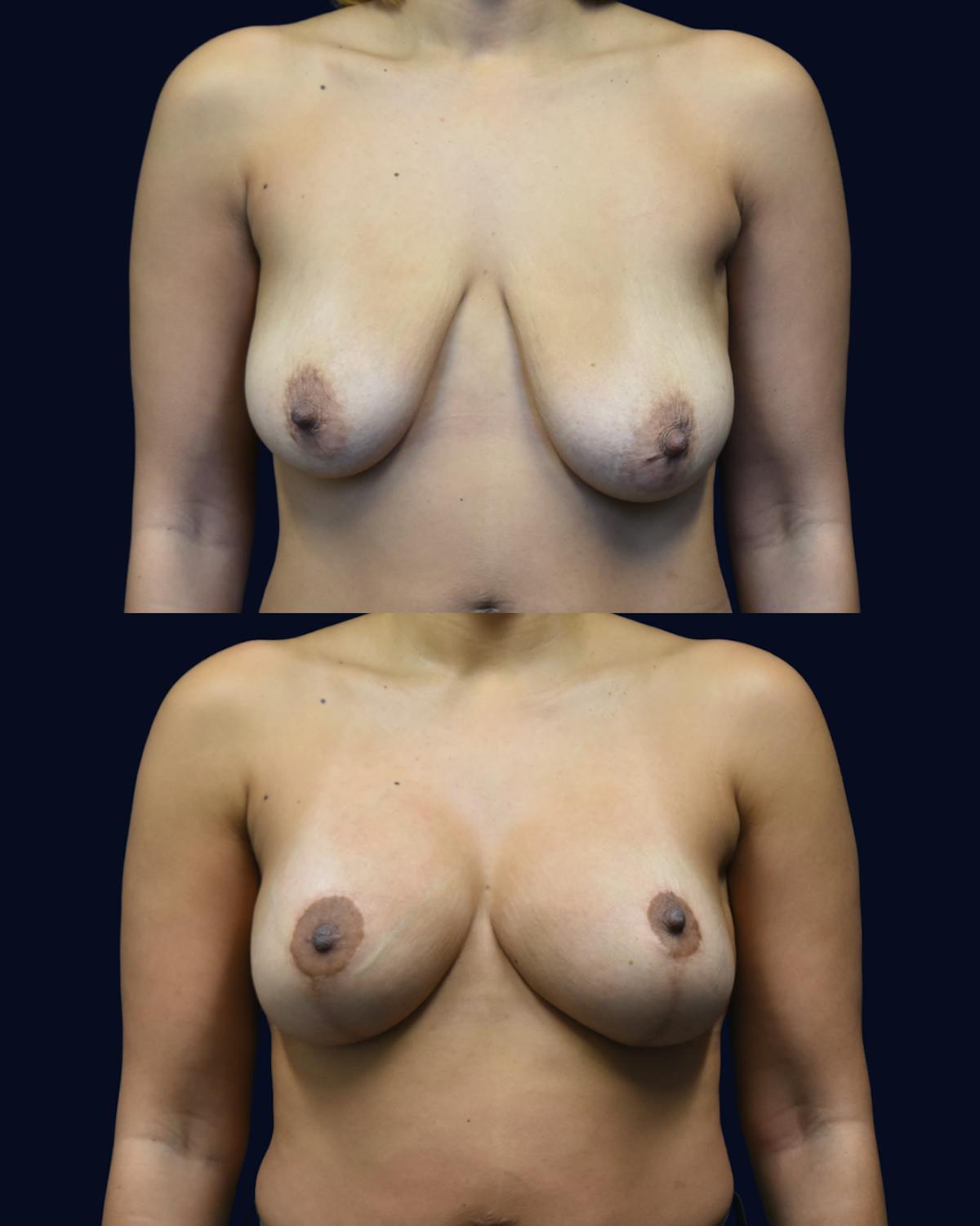 Breast Reduction and Lift Without Implants Before & After Gallery - Patient 294770 - Image 1