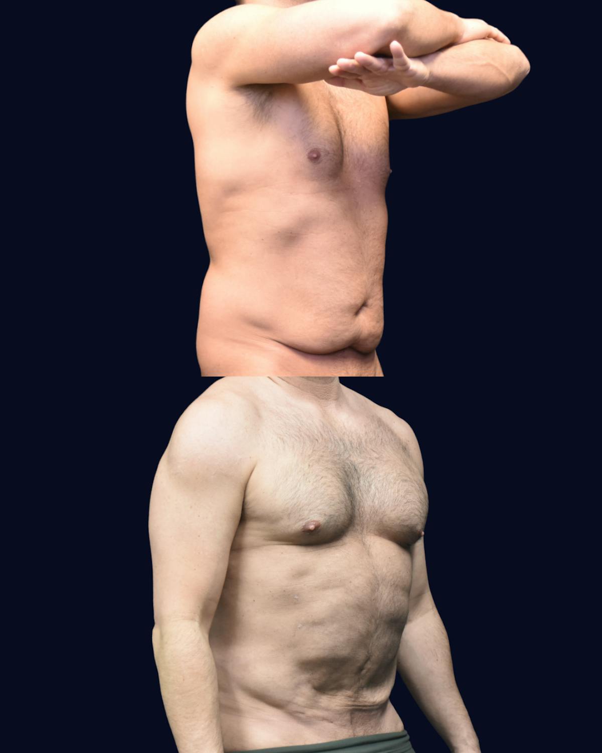 Male Liposuction Before & After Gallery - Patient 348859 - Image 2
