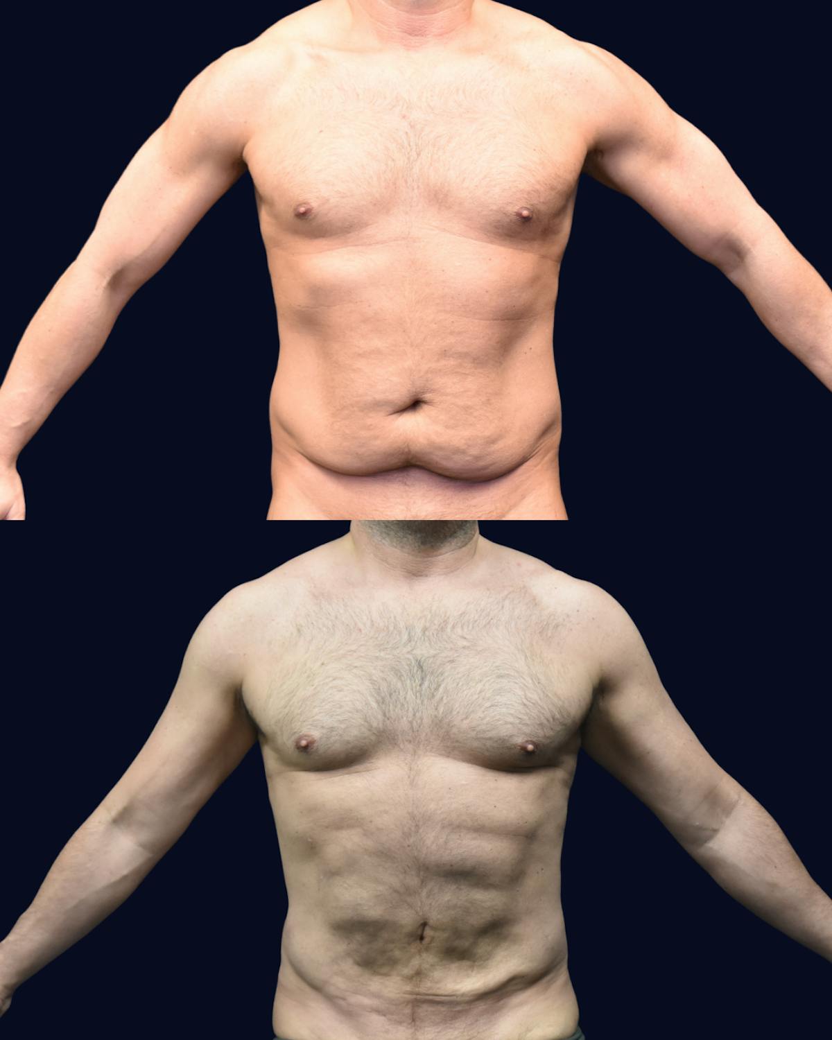 Male Liposuction Before & After Gallery - Patient 348859 - Image 1