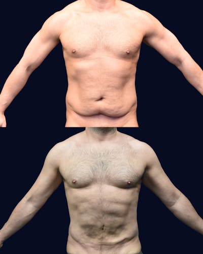 Male Liposuction Before & After Gallery - Patient 348859 - Image 1